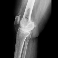BoneCancer